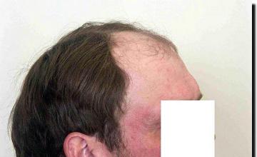 Hair restoration procedure results