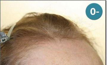 Hair restoration procedure results