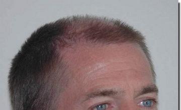 Hair restoration procedure results