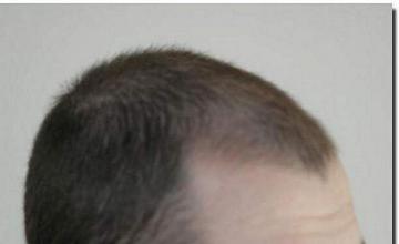 Hair restoration procedure results