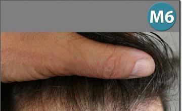 Hair restoration procedure results
