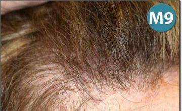 Hair restoration procedure results