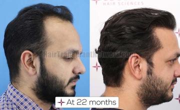 Right view of patient before and after