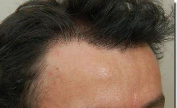 Hair restoration procedure results