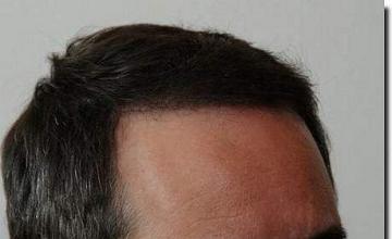 Hair restoration procedure results