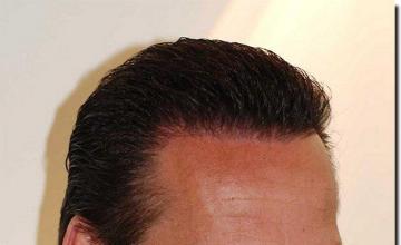 Hair restoration procedure results