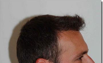 Hair restoration procedure results