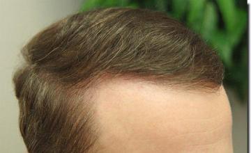 Hair restoration procedure results