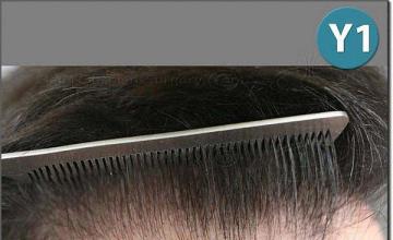 Hair restoration procedure results
