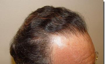 Hair restoration procedure results