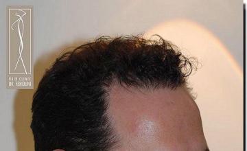 Hair restoration procedure results