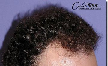 Hair restoration procedure results