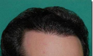 Hair restoration procedure results