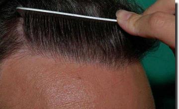 Hair restoration procedure results