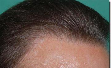 Hair restoration procedure results