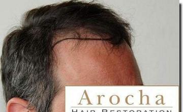 Hair restoration procedure results