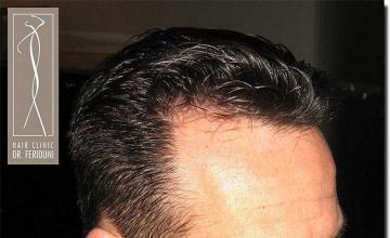 Hair restoration procedure results