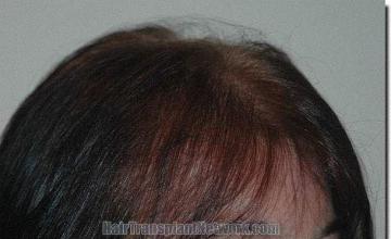 Hair restoration procedure results