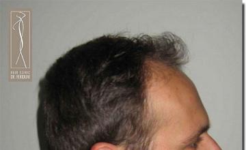 Hair restoration procedure results