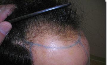 Hair restoration procedure results