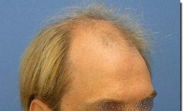 Hair restoration procedure results