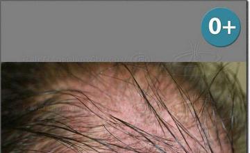 Hair restoration procedure results