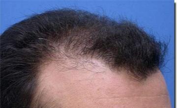 Hair restoration procedure results