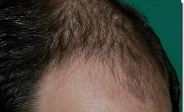 Hair restoration procedure results