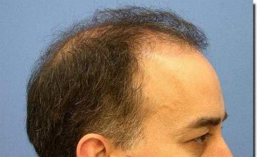 Hair restoration procedure results