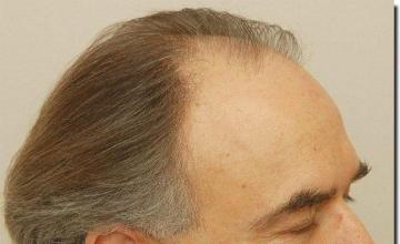 Hair restoration procedure results