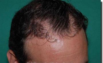 Hair restoration procedure results