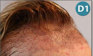 Hair restoration procedure results