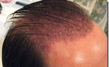 Hair restoration procedure results