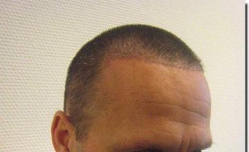 Hair restoration procedure results