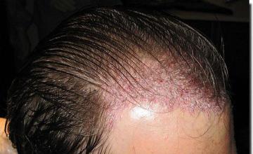 Hair restoration procedure results