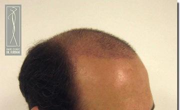 Hair restoration procedure results