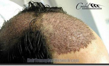 Hair restoration procedure results