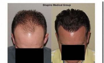 Hair restoration procedure results