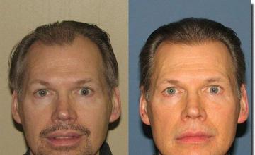 Hair restoration procedure results