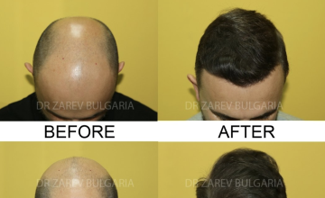 Before and After 