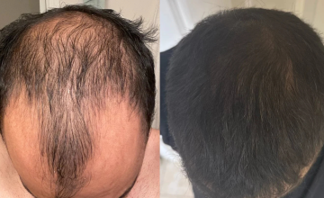 Dr. Ratchathorn Before and After
