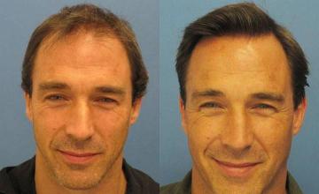 Front view - Before and after hair restoration procedure