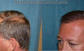 Left view before and after hair restoration pictures