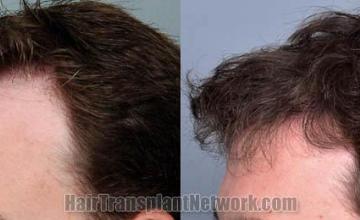 Hair transplantation surgery before and after images