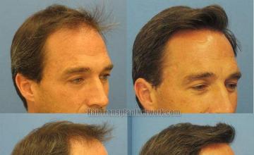 Right side and oblique views before and after hair restoration