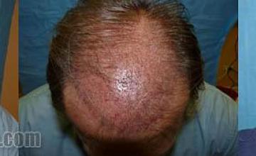 Top view before and after hair restoration procedure