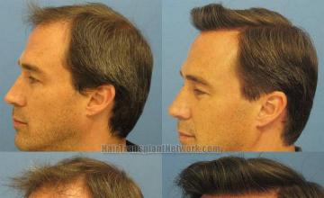 Left side before and after photos from 4692 graft hair replacement