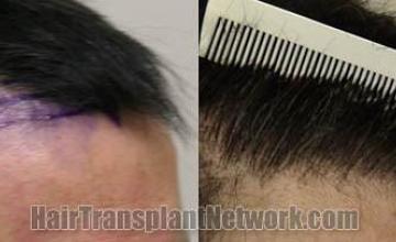 Hair restoration procedure results