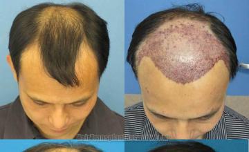 Top view before and after hair restoration images