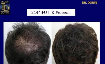 Back view before and after hair transplantation photos